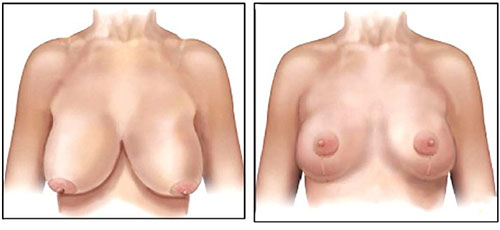 cheap breast reduction tunisia